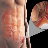 inguinal_Hernia_02.png