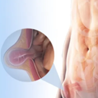 laparaskopik_fitik_04